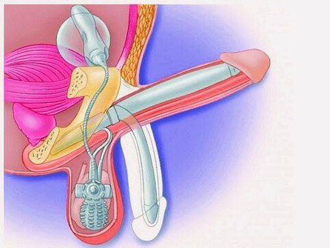 Penis enlargement using a penile prosthesis